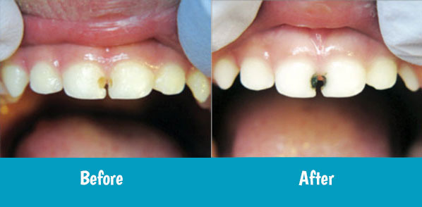 SDF Before and After